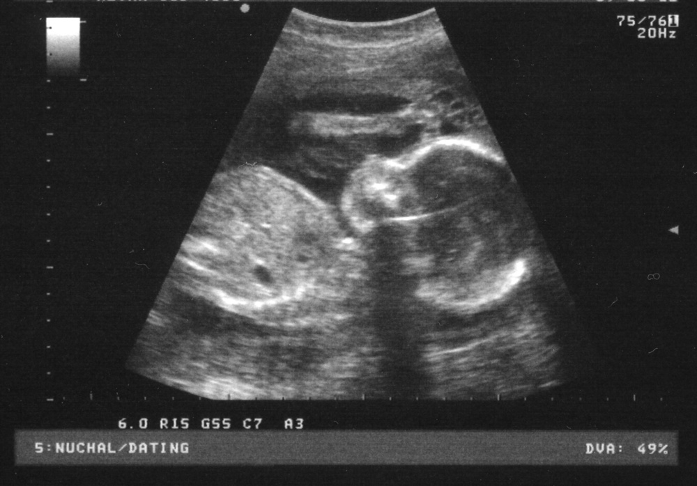 Ultrasounds